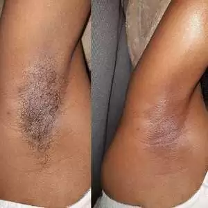 Before and after underarms waxing, Viv's in-Houz Spa; mobile waxing service in Nairobi