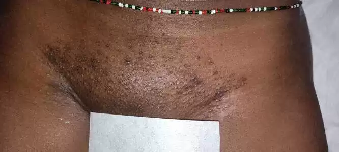 Smooth pubic zone after Brazilian waxing